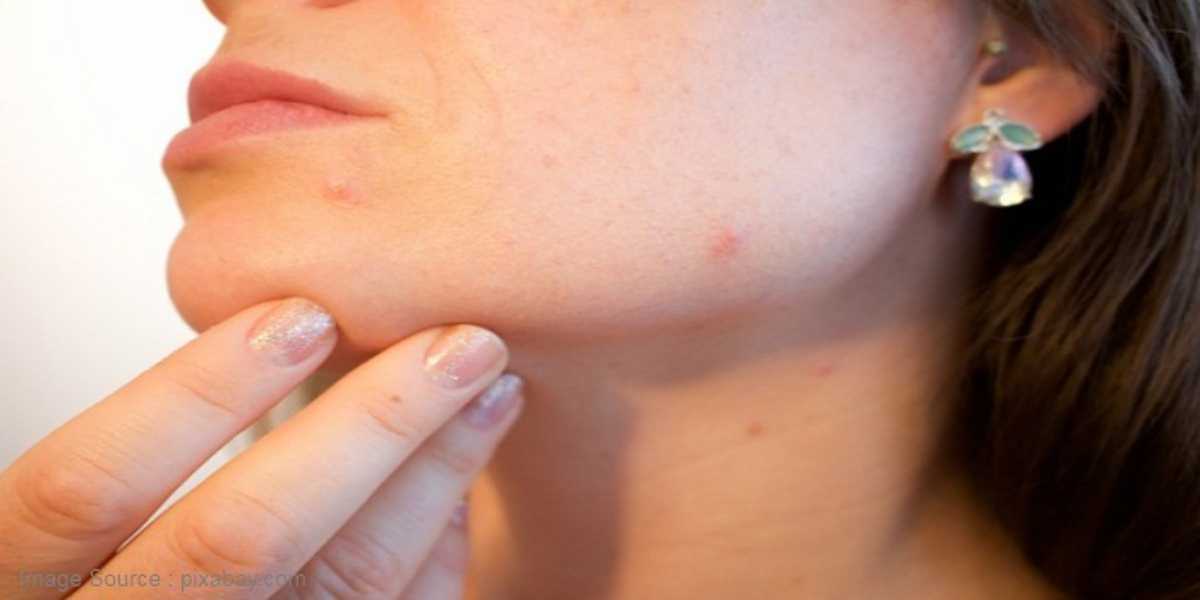 Acne Scar Causes