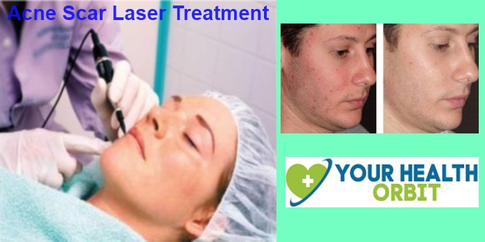 Acne Scar Laser Treatment