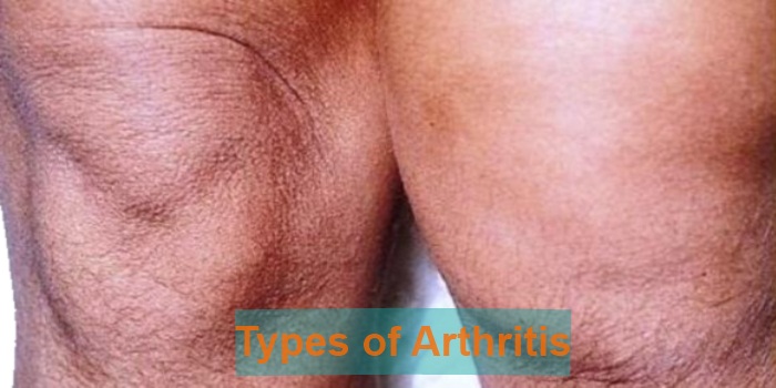 Types of Arthritis