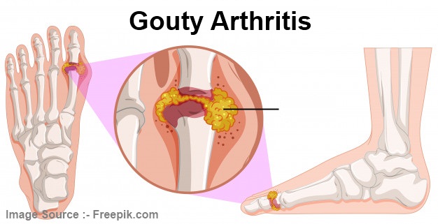 Gouty Arthritis