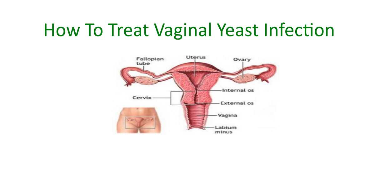 How To Treat Vaginal Yeast Infection