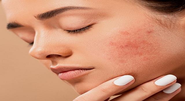 Remove Acne Scars